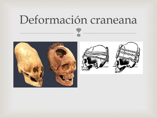 
Deformación craneana
 