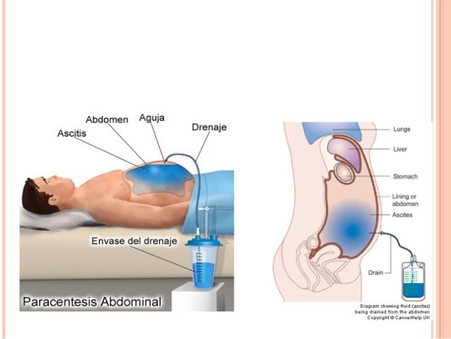 paracentesis