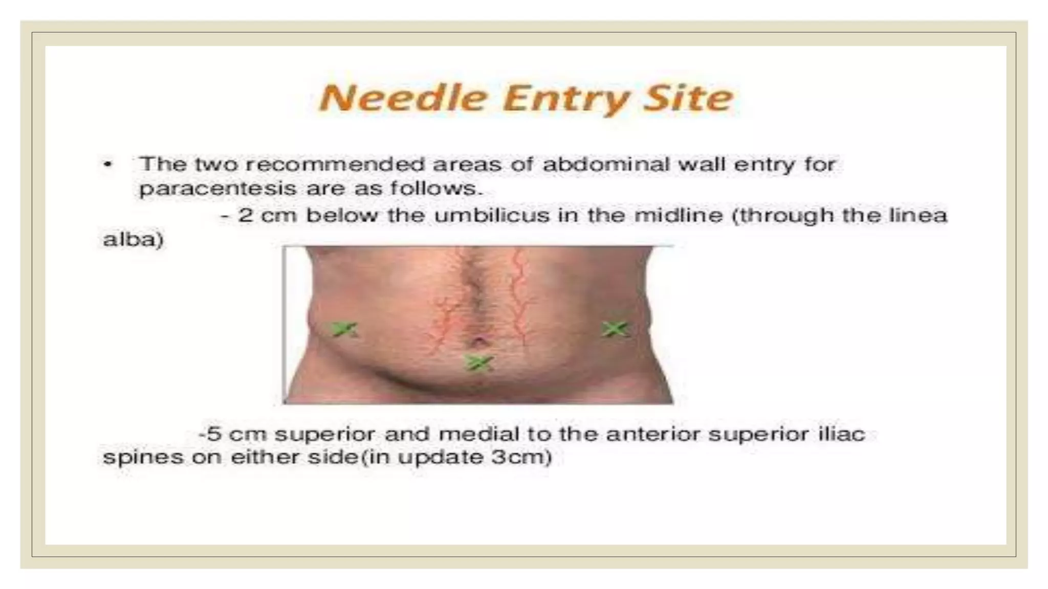 Paracentesis | PPTX