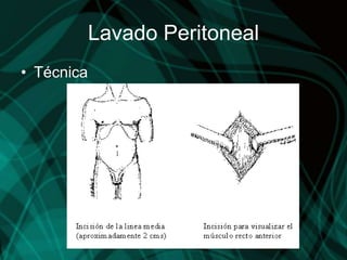 Lavado Peritoneal
• Técnica
 