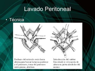 Lavado Peritoneal
• Técnica
 