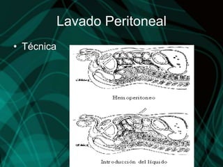 Lavado Peritoneal
• Técnica
 