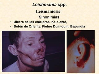 Leishmania spp.
               Leismaniosis
                Sinonimias
• Ulcera de los chicleros, Kala-azar,
• Botón de Oriente, Fiebre Dum-dum, Espundia
 