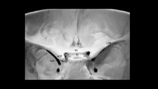 Paraclinoid aneurysms | PPTX