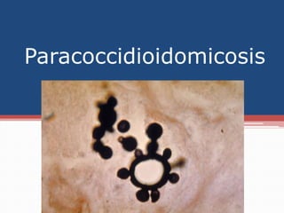Paracoccidioidomicosis
 