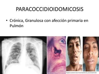 PARACOCCIDIOIDOMICOSIS
• Crónica, Granulosa con afección primaria en
Pulmón
 