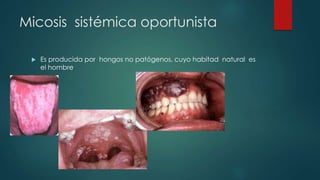 Micosis sistémica oportunista
 Es producida por hongos no patógenos, cuyo habitad natural es
el hombre
 