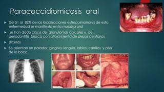 Paracoccidiomicosis oral
 Del 51 al 82% de las localizaciones estrapulmonares de esta
enfermedad se manifiesta en la mucosa oral
 se han dado casos de granulomas apicales y de
periodontitis brusca con aflojamiento de piezas dentarias
 Ulceras
 Se asientan en paladar, gingiva, lengua, labios, carrillos y piso
de la boca.
 