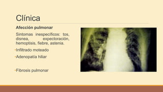 Clínica
Afección pulmonar
Sintomas inespecíficos: tos,
disnea, expectoración,
hemoptisis, fiebre, astenia.
•Infiltrado moteado
•Adenopatía hiliar
•Fibrosis pulmonar
 