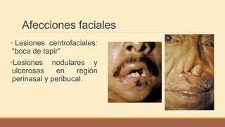 Afecciones faciales
• Lesiones centrofaciales:
“boca de tapir”
•Lesiones nodulares y
ulcerosas en región
perinasal y peribucal.
 