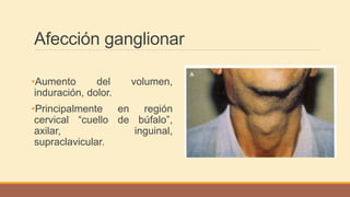 Afección ganglionar
•Aumento del volumen,
induración, dolor.
•Principalmente en región
cervical “cuello de búfalo”,
axilar, inguinal,
supraclavicular.
 