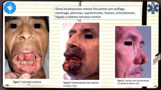 Otras localizaciones menos frecuentes son esófago,
estomago, páncreas, suprarrenales, huesos, articulaciones,
hígado y sistema nervioso central
 