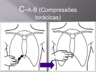 C-A-B (Compressões
torácicas)
 