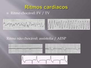  Ritmo chocável: FV / TV
Ritmo não chocável: assistolia / AESP
 
