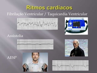 Fibrilação Ventricular / Taquicardia Ventricular
Assistolia
AESP
 