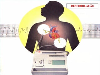 DESFIBRILAÇÃO
 