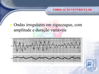FIBRILAÇÃO VENTRICULAR




♥   Ondas irregulares em ziguezague, com
    amplitude e duração variáveis
 