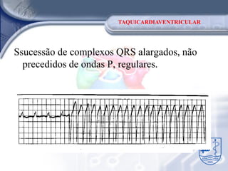 TAQUICARDIAVENTRICULAR




Ssucessão de complexos QRS alargados, não
  precedidos de ondas P, regulares.
 