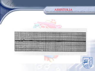 ASSISTOLIA
 