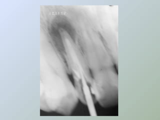 Paraendodôntica uepg