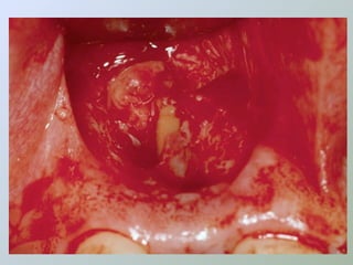 Paraendodôntica uepg