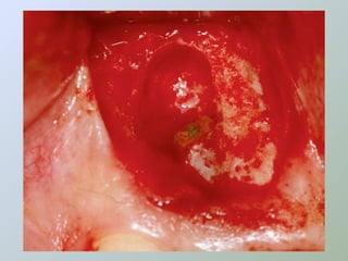 Paraendodôntica uepg