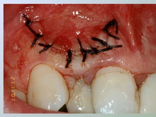 Paraendodôntica uepg