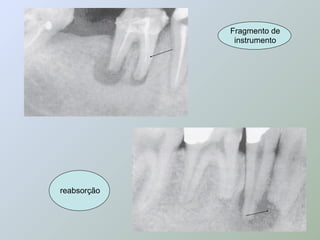 Fragmento de
              instrumento




reabsorção
 