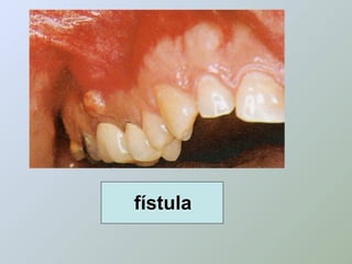 fístula
 