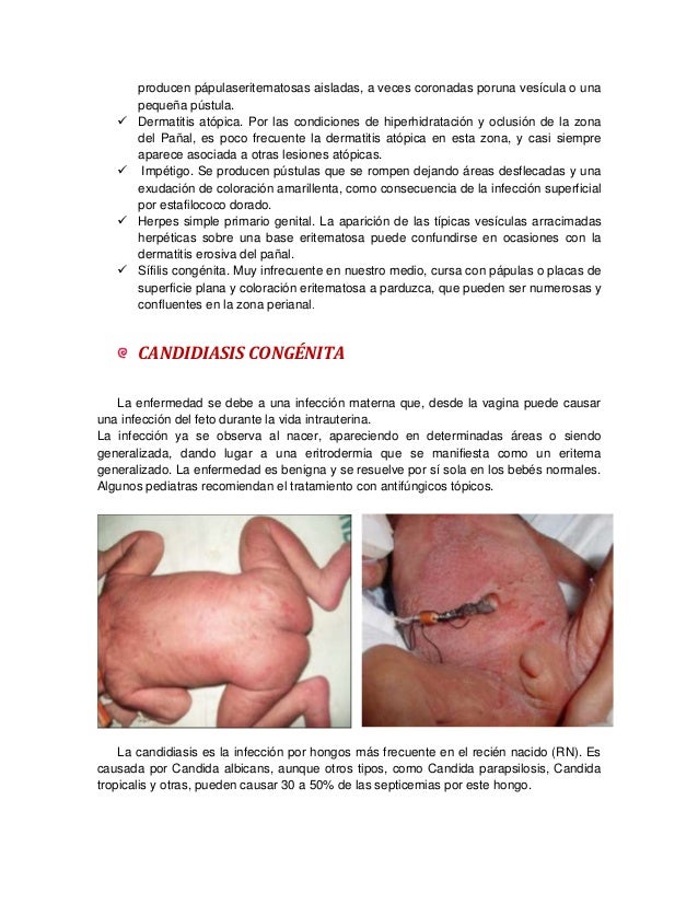 DERMATITIS DE PA AL dermatitis-de-pa-al