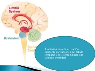 Asociación entre la activación
mediante convulsiones del lóbulo
temporal y el sistema límbico con
la hipersexualidad
 