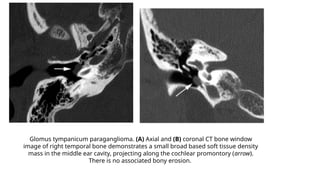Paragangliomas by Dr. Prakriti.pptx · version 1-1.pptx