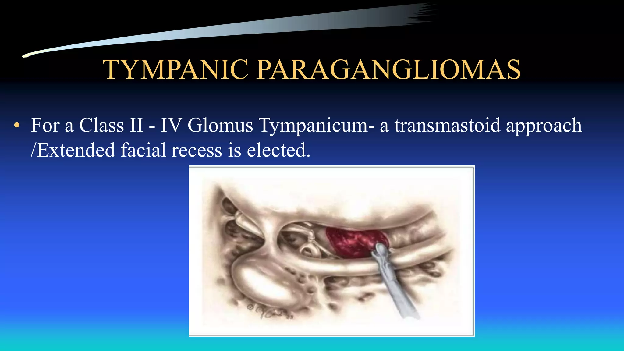 Retroauricular Approach Paragangliomas of head and neck | PPTX