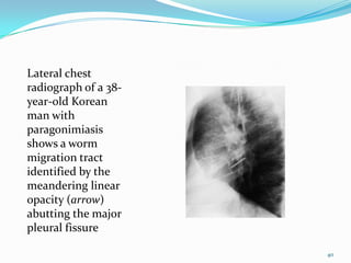 Lateral chest
radiograph of a 38-
year-old Korean
man with
paragonimiasis
shows a worm
migration tract
identified by the
meandering linear
opacity (arrow)
abutting the major
pleural fissure

                      40
 