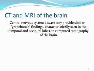 CT and MRI of the brain
  Central nervous system disease may provide similar
   "grapebunch“ findings, characteristically seen in the
 temporal and occipital lobes on computed tomography
                      of the brain




                                                       42
 