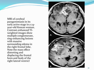 MRI of cerebral
paragonimiasis in its
early active stage in a 24-
year-old Korean woman.
Contrast-enhanced TI-
weighted images show
multiple conglomerate,
ring-enhancing lesions
with massive
surrounding edema in
the right frontal lobe.
Note the mass effect
distorting and
displacing the frontal
horn and body of the
right lateral ventricl

                              44
 