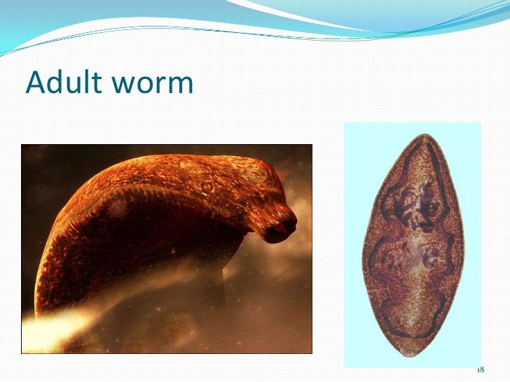 Paragonimiasis (lung fluke disease)