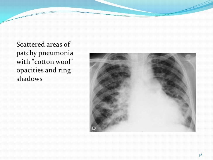 Paragonimiasis (lung fluke disease)