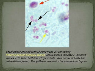 acute, nonbloody diarrhea with crampyabdpain (weeks)--malabsorption& wt loss. immuno-depressed patients , infants & children—severe diarrhea.  EosinophiliaClinical Features: