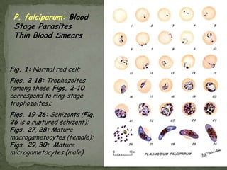 Causal Agent:Dientamoebafragilis is not an ameba but a flagellate.  parasite produces trophozoites; cysts have not been identified. Geographic Distribution:Worldwide.