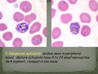 children –intermittent diarrhea, abd pain, n/v, anorexia, fatigue, malaise, poor  wt gainClinical Features: