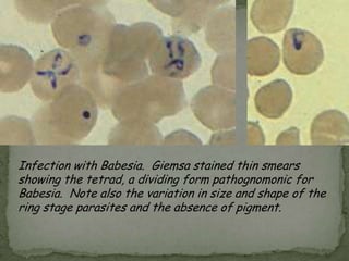 Stool smear stained with Chromotrope 2R containing Enterocytozoon bieneusi spores. Black arrows indicate E. bieneusi spores with their belt-like stripe visible.  Red arrow indicates an unidentified yeast.  The yellow arrow indicates a vacuolated spore.