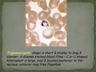 Gametocytes of P. falciparum in thin blood smears.  Note the presence of a “Laveran’s bib”, which is not always visible.