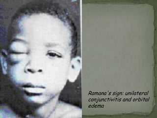 P. malariae trophozoites: have compact cytoplasm and a large chromatin dot.  Occasional band forms and/or "basket" forms with coarse, dark-brown pigment can be seen.