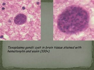 Babesia microti infection, Giemsa stained thin smear.  The organisms resemble P. falciparum; however Babesia parasites present several distinguishing features: they vary more in shape and in size; and they do not produce pigment. 