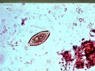 Trichomonas vaginalis:flagellates are 10-30 µm in lenght and 6-20 µm in breadth. Flagella, nucleus, axostyle and undullating membrane are visible. Filamentous form of Lactobacillus Döderleini is present. Giemsa-Romanowski stain.
