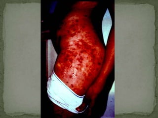 Adult Ascaris worm: tapered ends; length 15 to 35 cm (the females tend to be the larger ones).  This worm is a female, as evidenced by the size and genital girdle (the dark circular groove at bottom area of image).