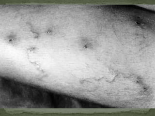 Causal Agent:Ascarislumbricoidesis the largest nematode (Adult females: 20 to 35 cm; adult male: 15 to 30 cm.)Geographic Distribution:most common human helminthic infection.  Worldwide distribution.  Highest prevalence in tropical and subtropical regions, and areas with inadequate sanitation. 