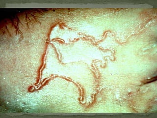 Effects of Adult Ascaris WormsDepends on worm loadEffectsMechanical: obstruction, volvulus, intussusception, appendicitis, obstructive jaundice, liver abscesses, pancreatitis, asphyxiaToxic and MetabolicMalnutrition (complex)