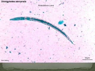 Case 138-yr-old schoolgirl visiting the U.S. from Malaysia1 week history of epigastric pain, flatulence, anorexia, bloody diarrheaNo eosinophilia notedClinical diagnosis of amoebic dysentery made However, microscopy of stool prep…
